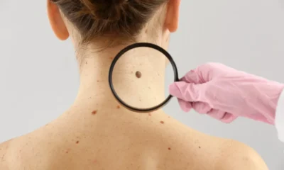 Alerta de Saúde: Melanomas Raros e os Riscos Fora da Pele