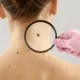 Alerta de Saúde: Melanomas Raros e os Riscos Fora da Pele