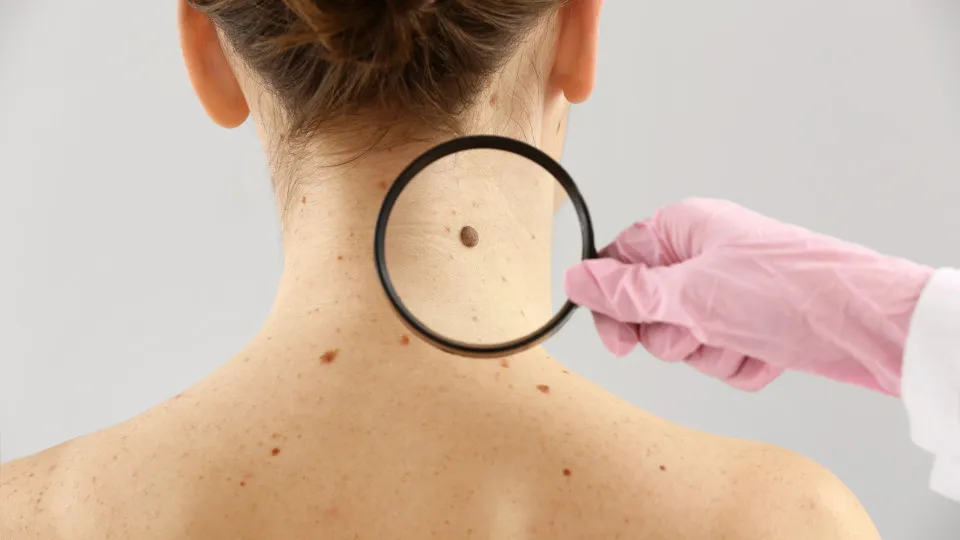 Alerta de Saúde: Melanomas Raros e os Riscos Fora da Pele Alerta de Saúde: Melanomas Raros e os Riscos Fora da Pele