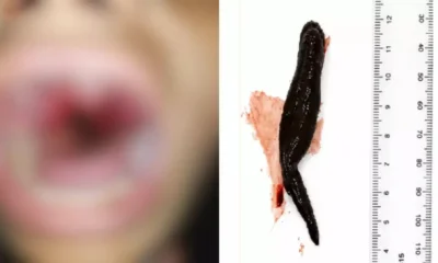 Alerta Médico: Menina de 12 Anos Vive com Sanguessuga de 8cm na Garganta por Uma Semana no Afeganistão