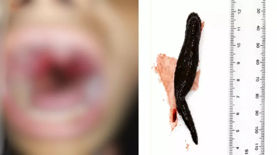 Alerta Médico: Menina de 12 Anos Vive com Sanguessuga de 8cm na Garganta por Uma Semana no Afeganistão Alerta Médico: Menina de 12 Anos Vive com Sanguessuga de 8cm na Garganta por Uma Semana no Afeganistão