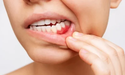 Retração Gengival: Causas, Prevenção e Impacto na Saúde Bucal