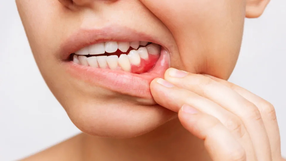 Retração Gengival: Causas, Prevenção e Impacto na Saúde Bucal Retração Gengival: Causas, Prevenção e Impacto na Saúde Bucal